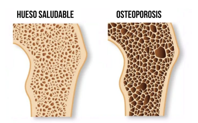 osteoporosis-1