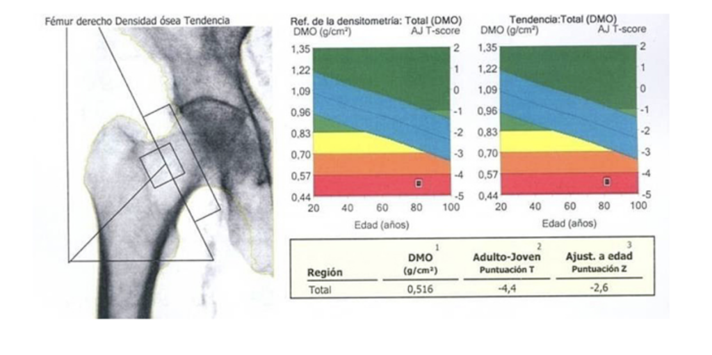 osteoporosis-4