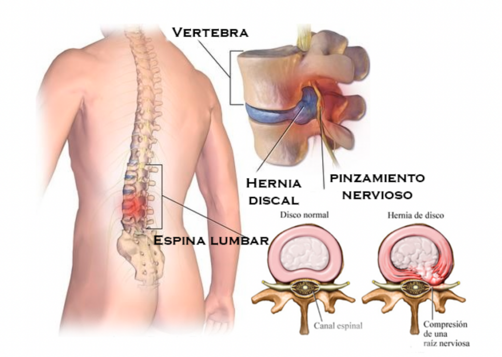 lumbalgia-tipos-2